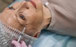 Rhinoplasty