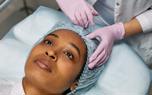 Facelift surgery