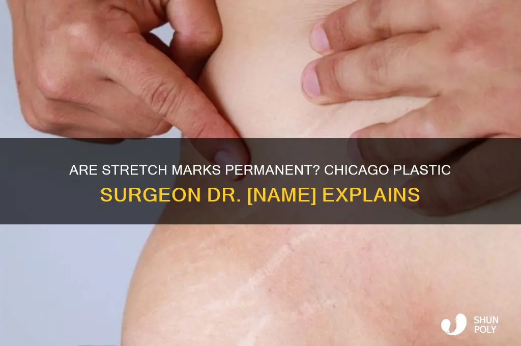 are stretch marks permanent chicago plastic surgeon dr