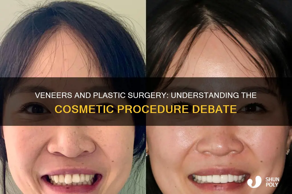 are veneers considered plastic surgery