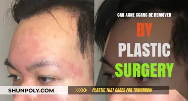 Plastic Surgery Solutions: Can Acne Scars Be Effectively Removed?