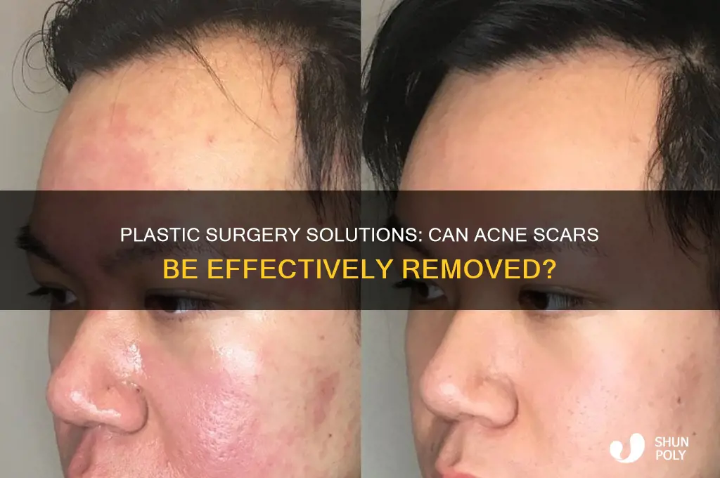 can acne scars be removed by plastic surgery