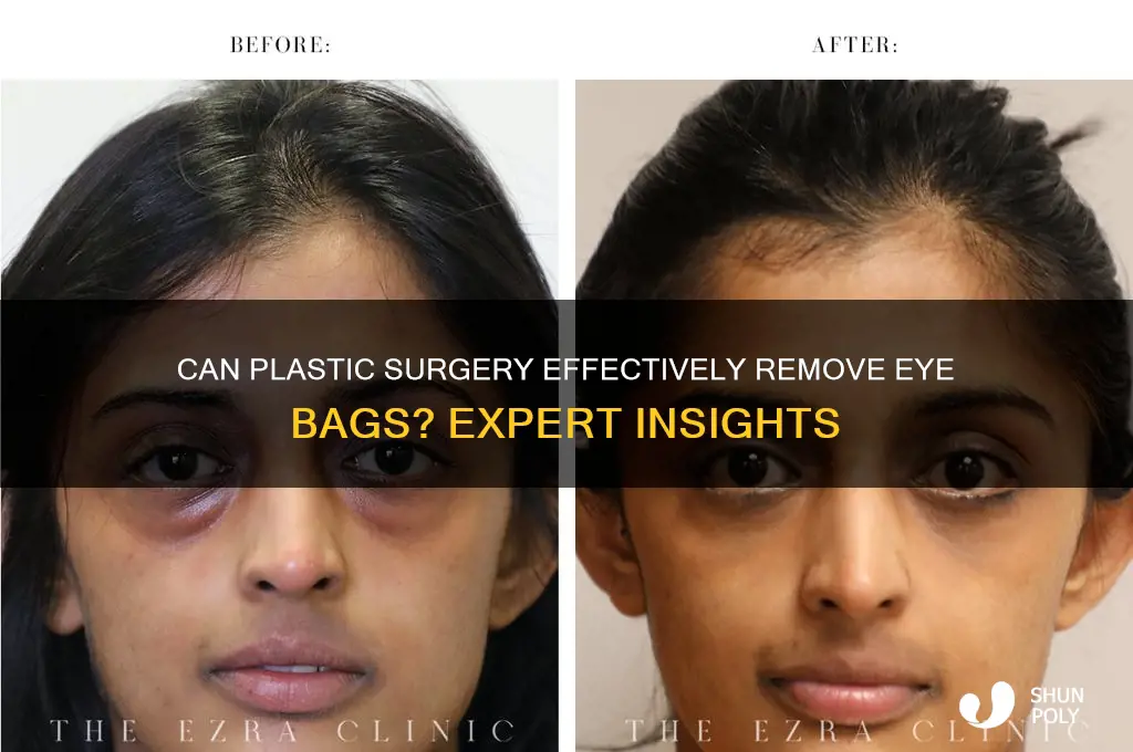 can eye bags be removed with plastic surgery