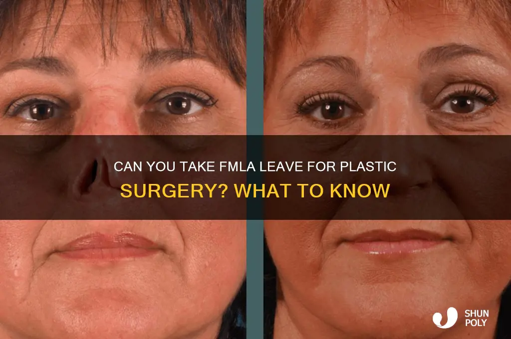 can i get fmla for plastic surgery