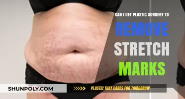 Can Plastic Surgery Effectively Remove Stretch Marks? Exploring Your Options