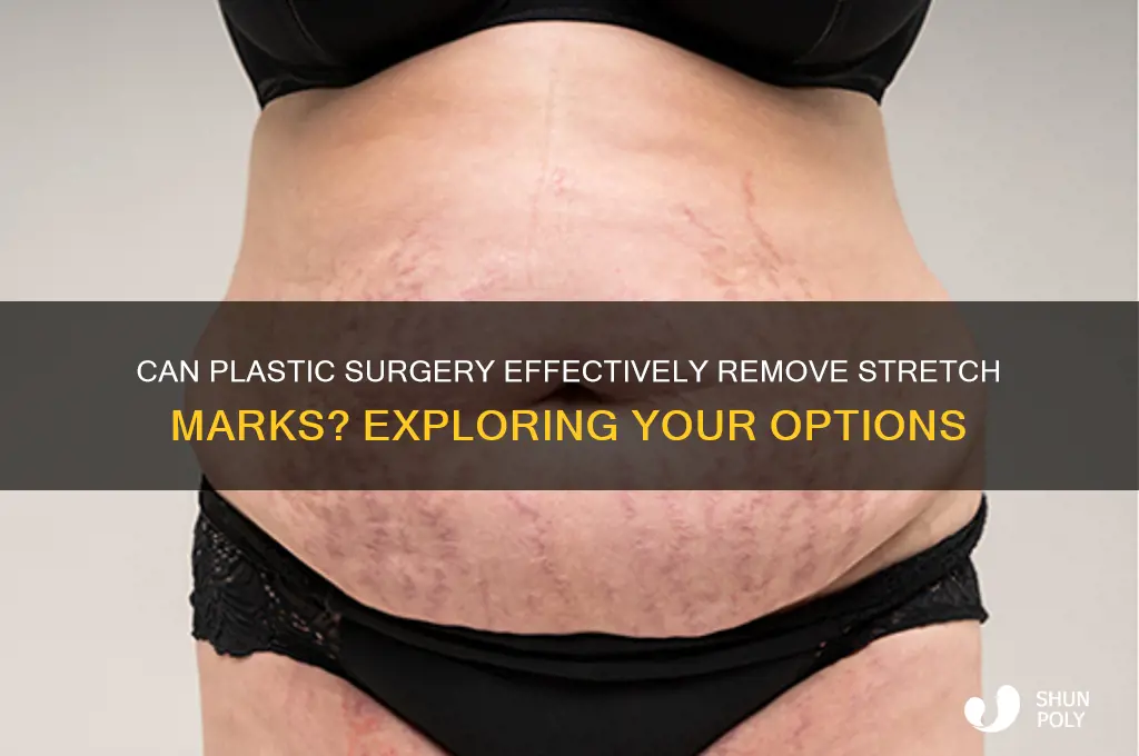 can i get plastic surgery to remove stretch marks