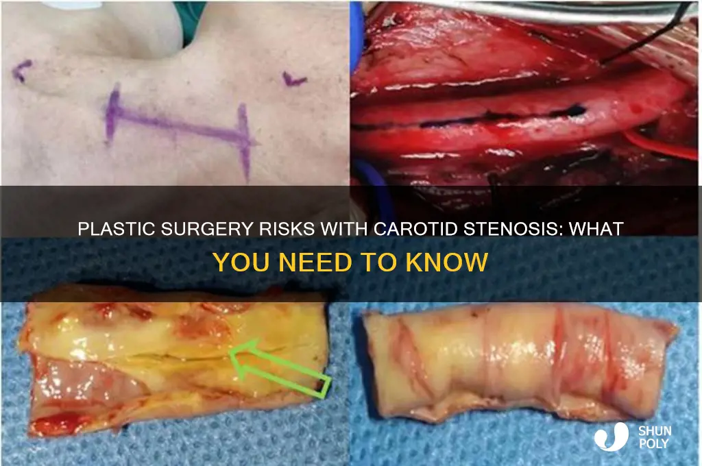 can i have plastic surgery with carotid stenosis