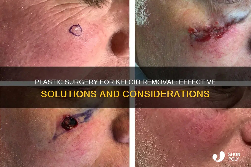 can keloids be removed with plastic surgery
