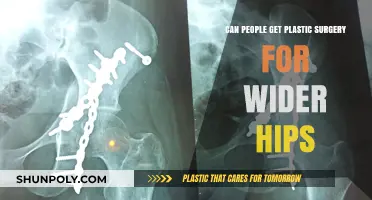 Wider Hips Through Plastic Surgery: Is It Possible?