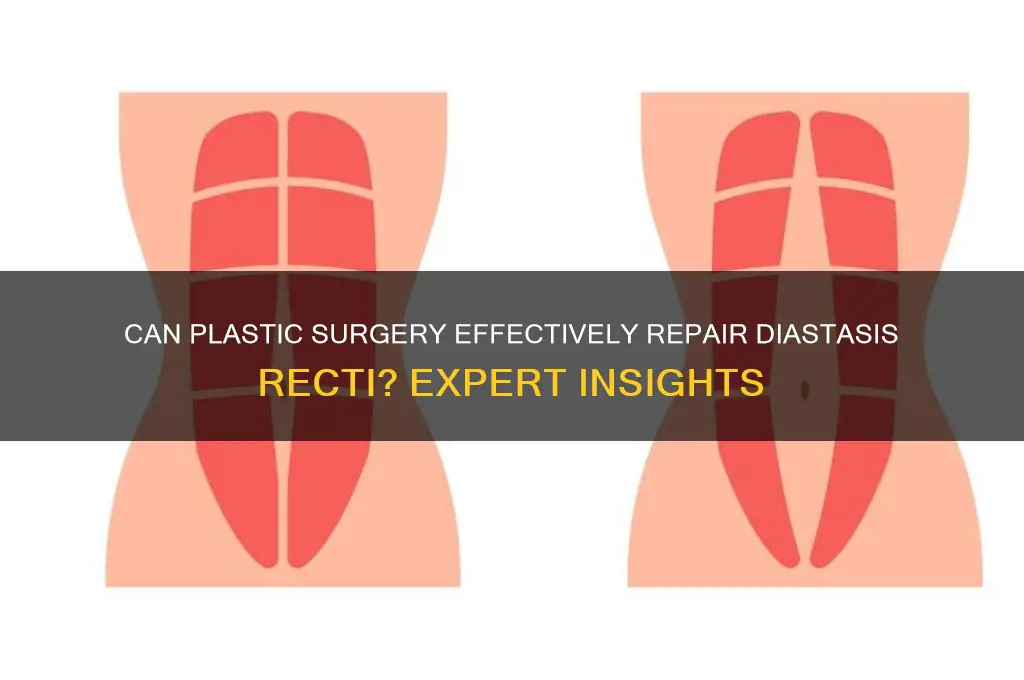 Can Plastic Surgery Effectively Repair Diastasis Recti? Expert Insights ...