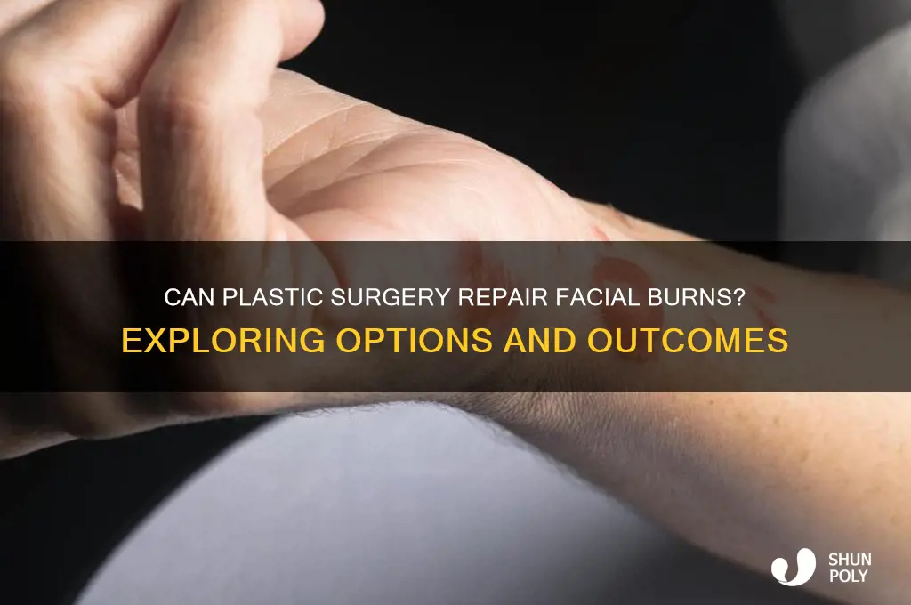 can plastic surgery fix facial burns