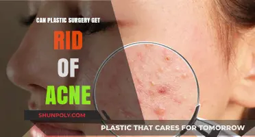 Can Plastic Surgery Eliminate Acne? Exploring Treatment Options and Results