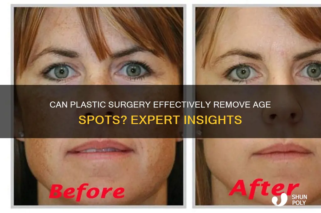 can plastic surgery get rid of age spots