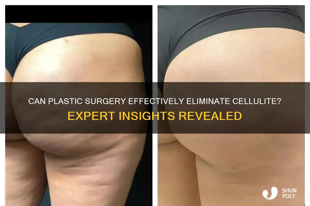 can plastic surgery get rid of cellulite