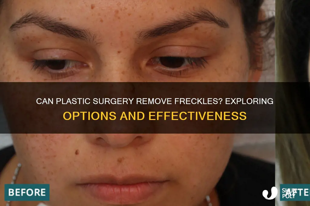 can plastic surgery get rid of freckles