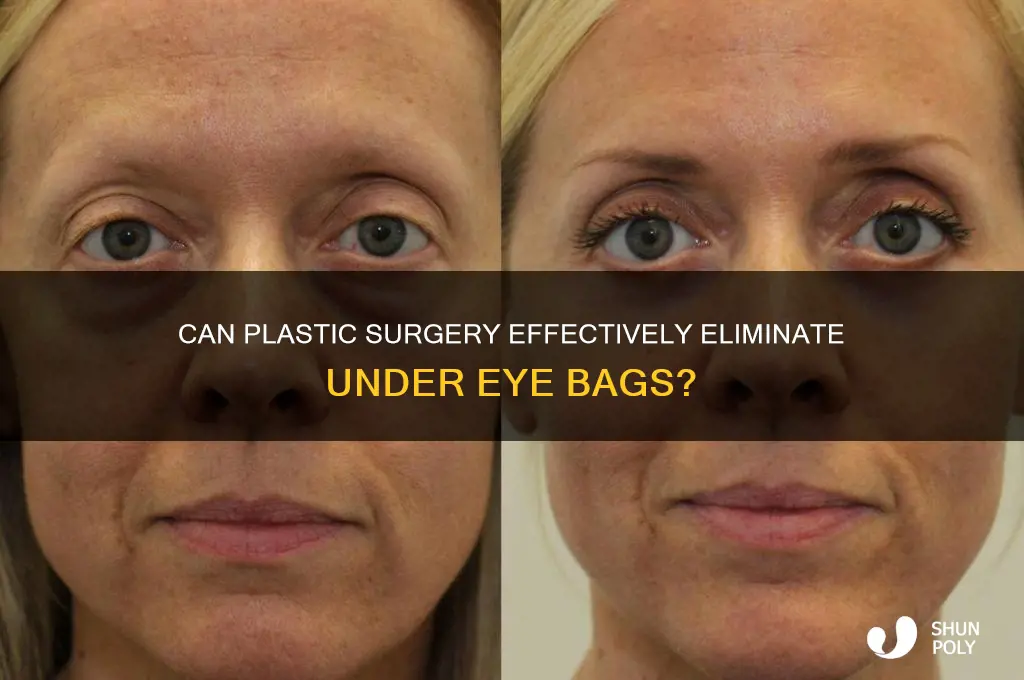 can plastic surgery get rid of under eye bags