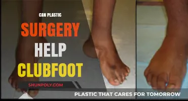 Can Plastic Surgery Correct Clubfoot? Exploring Treatment Options and Outcomes