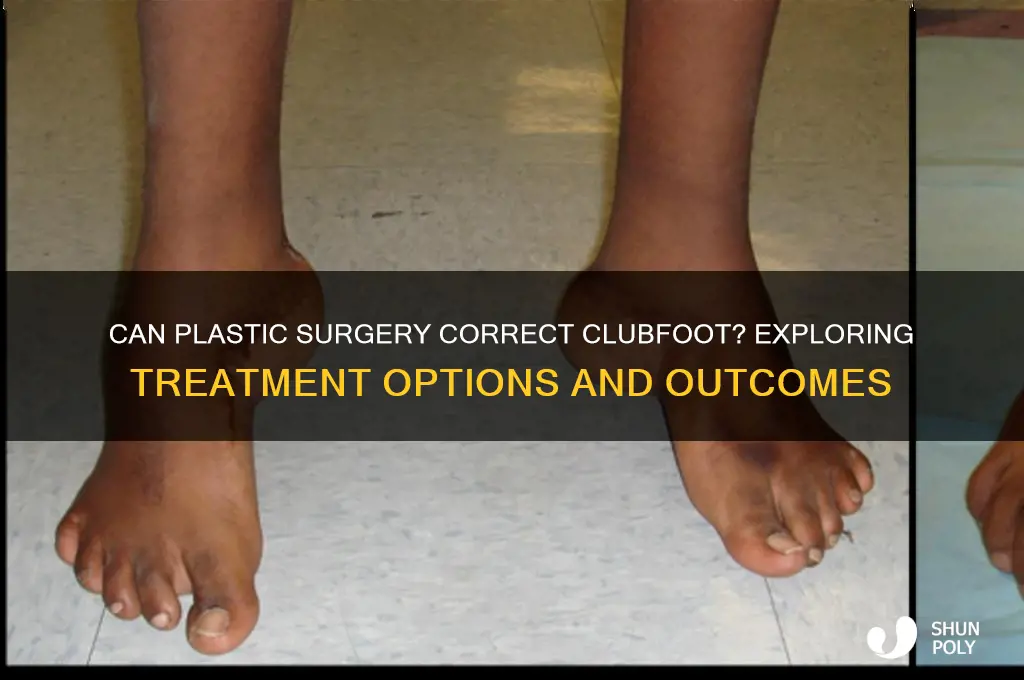 can plastic surgery help clubfoot