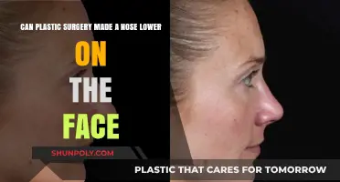 Can Rhinoplasty Lower Your Nose's Position on the Face?