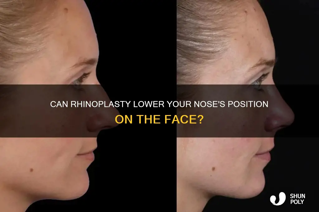 can plastic surgery made a nose lower on the face
