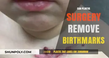 Can Plastic Surgery Remove Birthmarks? Exploring Options and Limitations