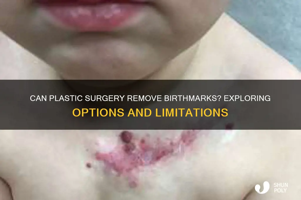 can plastic surgery remove birthmarks