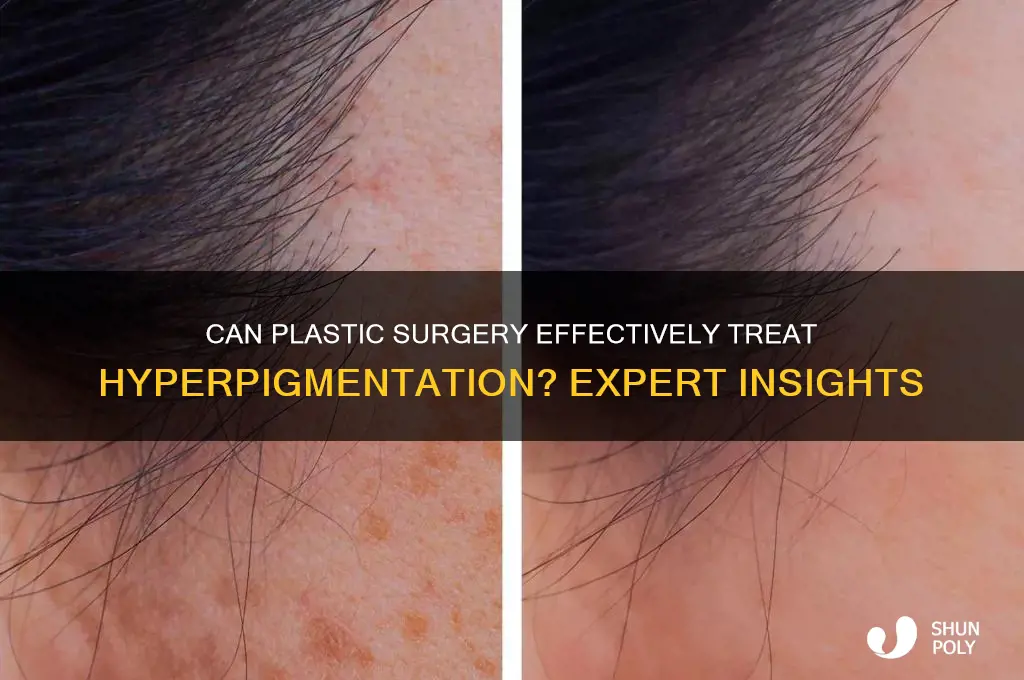 can plastic surgery remove hyperpigmentation