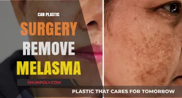 Can Plastic Surgery Effectively Treat or Remove Melasma?