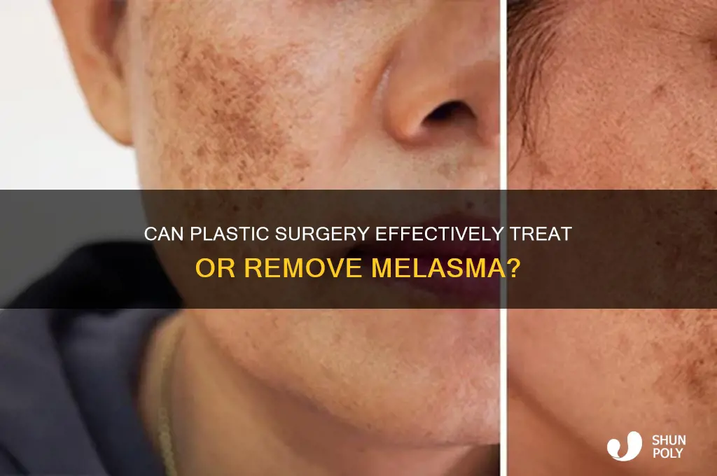 can plastic surgery remove melasma