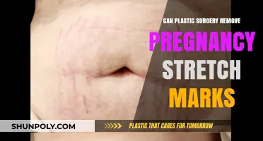 Can Plastic Surgery Effectively Remove Pregnancy Stretch Marks?