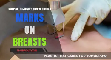 Can Plastic Surgery Effectively Remove Stretch Marks on Breasts?