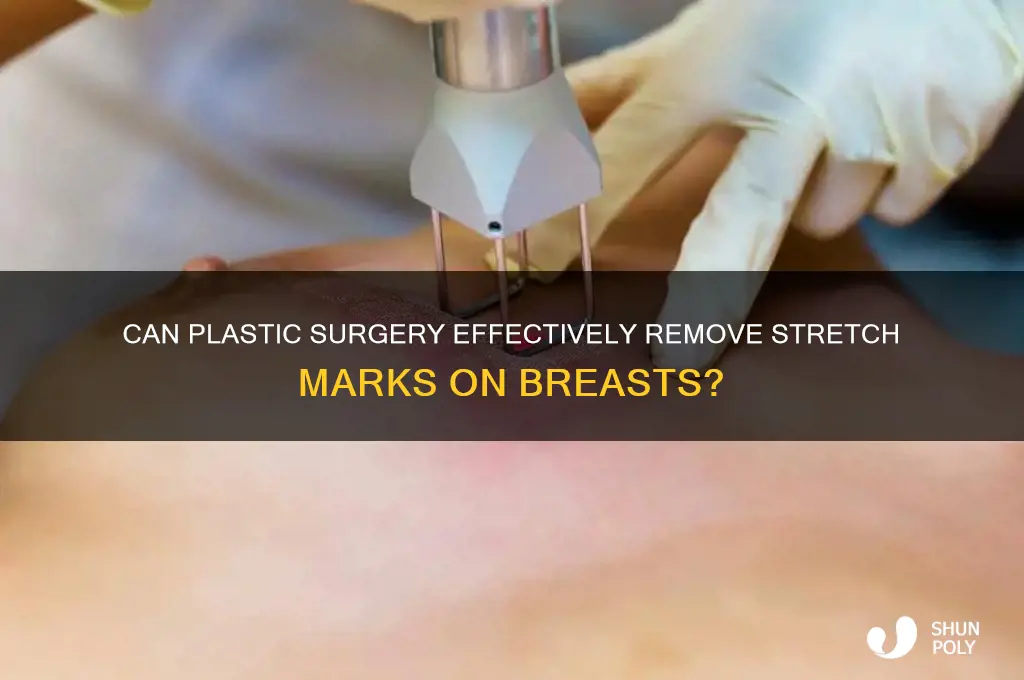 can plastic surgery remove stretch marks on breasts