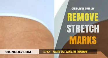 Can Plastic Surgery Effectively Remove Stretch Marks? Expert Insights