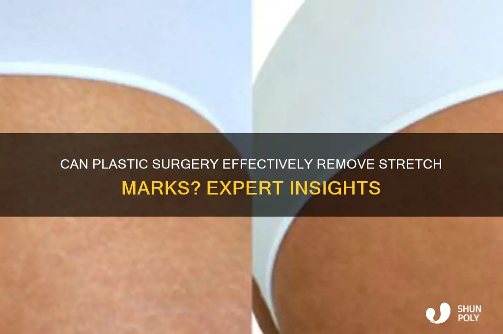 can plastic surgery remove stretch marks