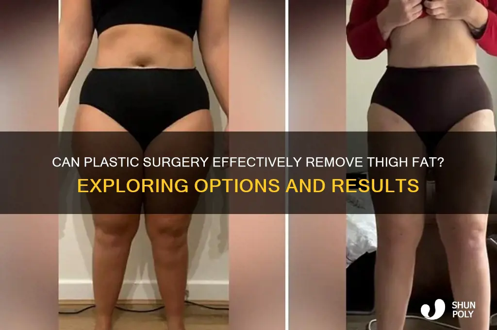 can plastic surgery remove thigh fat