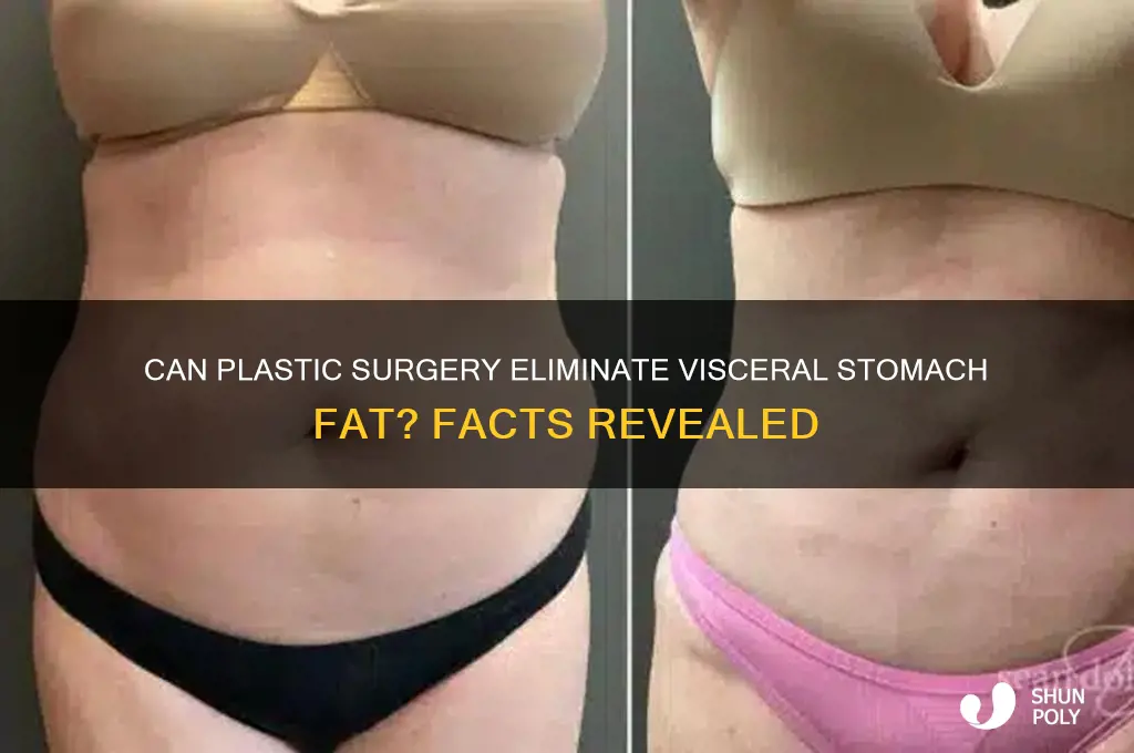 can visceral fat in stomach be removed by plastic surgery
