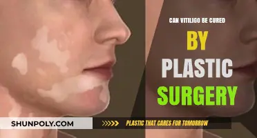 Can Plastic Surgery Cure Vitiligo? Exploring Treatment Options and Results
