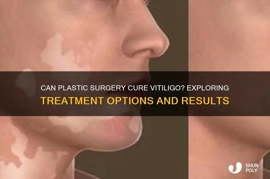 can vitiligo be cured by plastic surgery