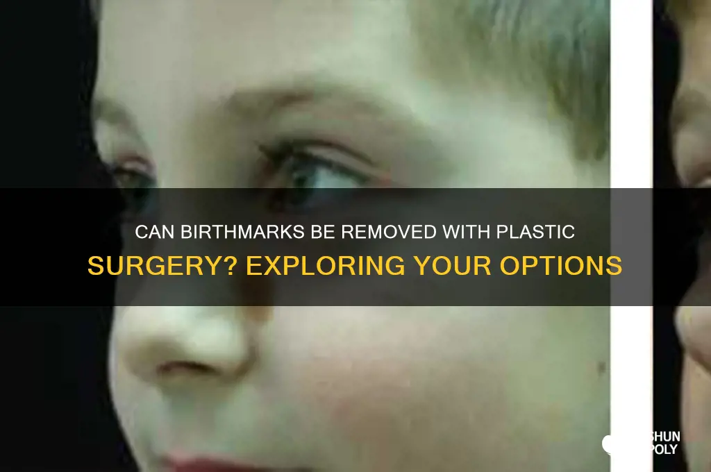 can you get plastic surgery for birth marks