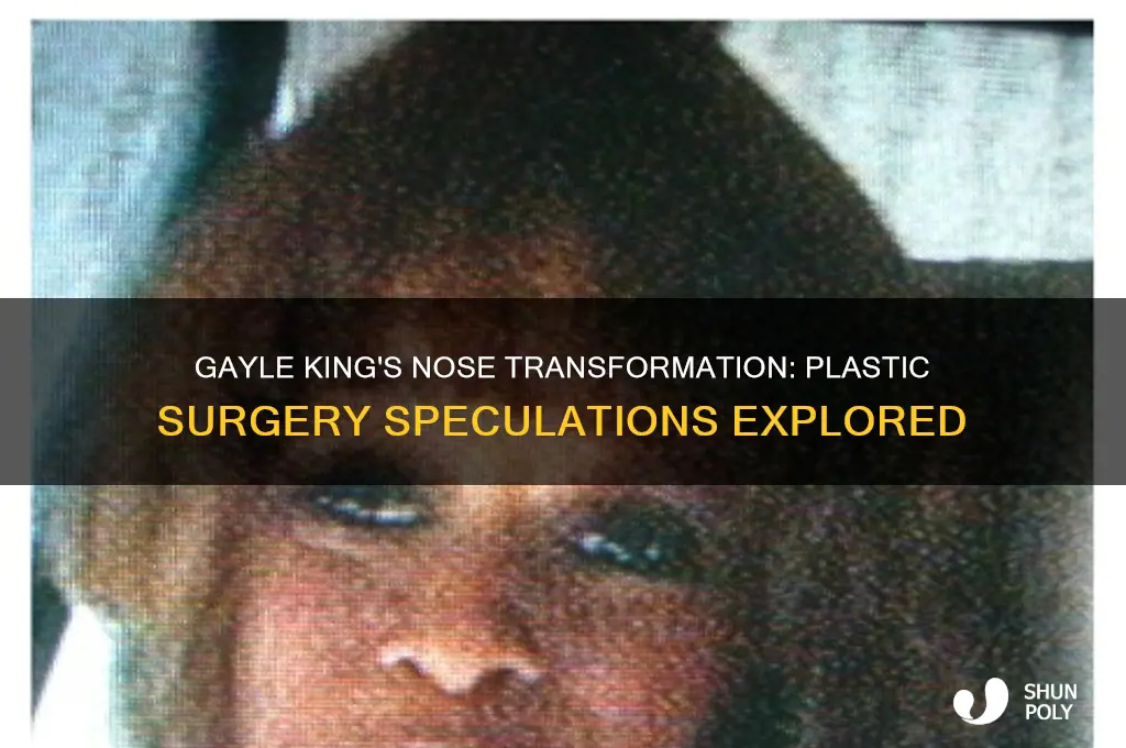 did gayle king have plastic surgery on her nose