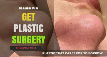 Did Hannah Stark Undergo Plastic Surgery? Unveiling the Truth