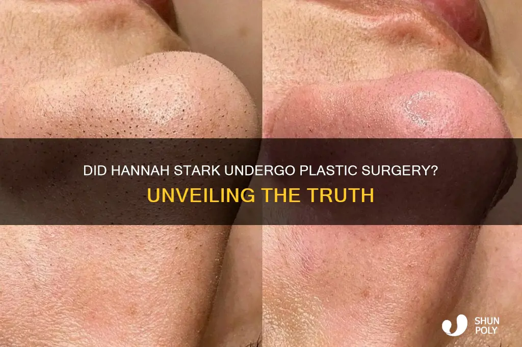 did hannah stark get plastic surgery