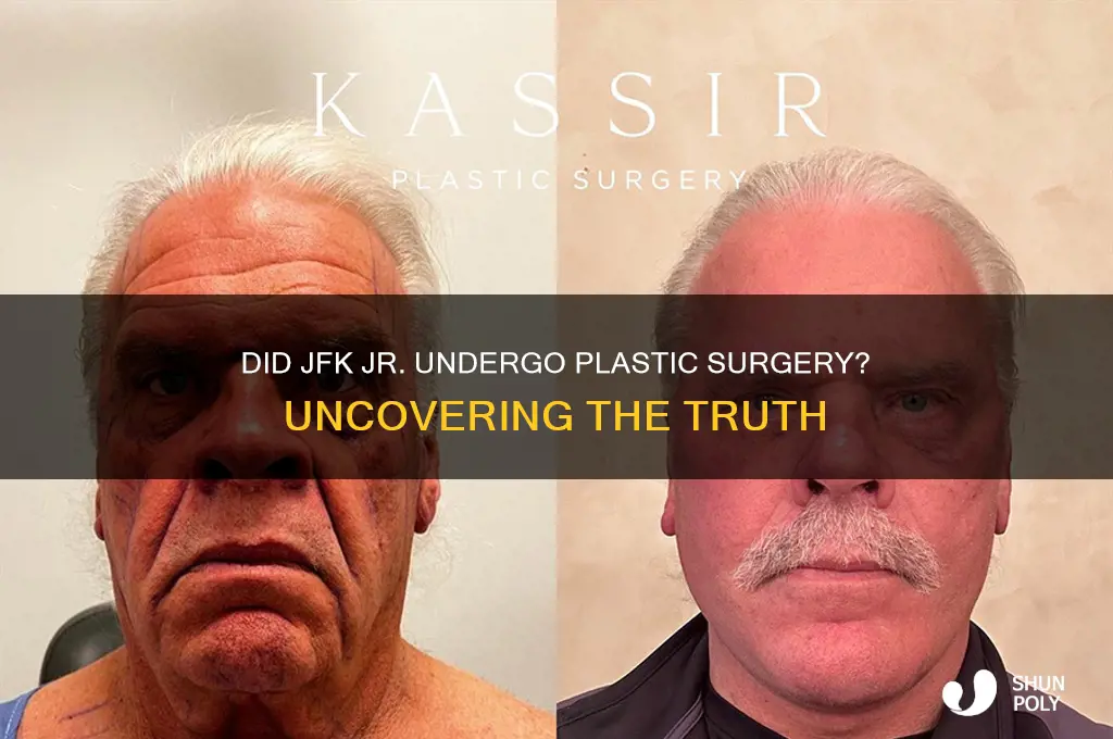 did jfk jr have plastic surgery