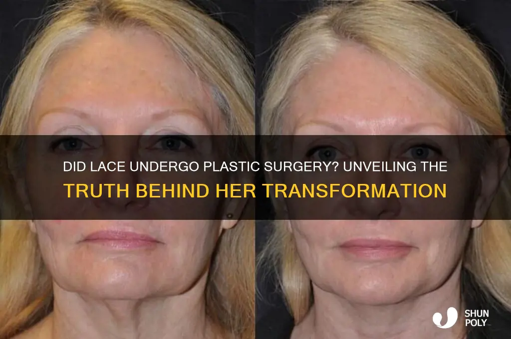 did lace get plastic surgery