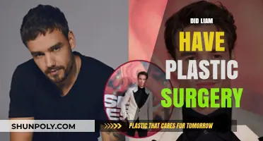 Did Liam Undergo Plastic Surgery? Unveiling the Truth Behind the Rumors