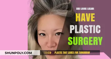 Louis Licari Plastic Surgery: Fact or Fiction? Unveiling the Truth
