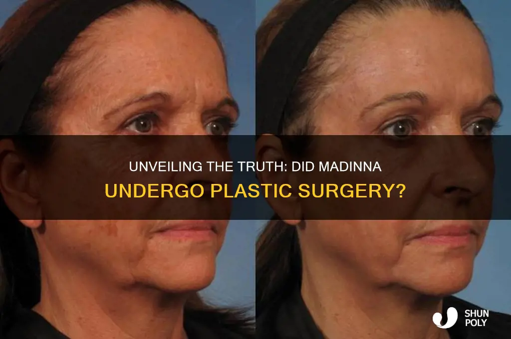 did madinna have plastic surgery