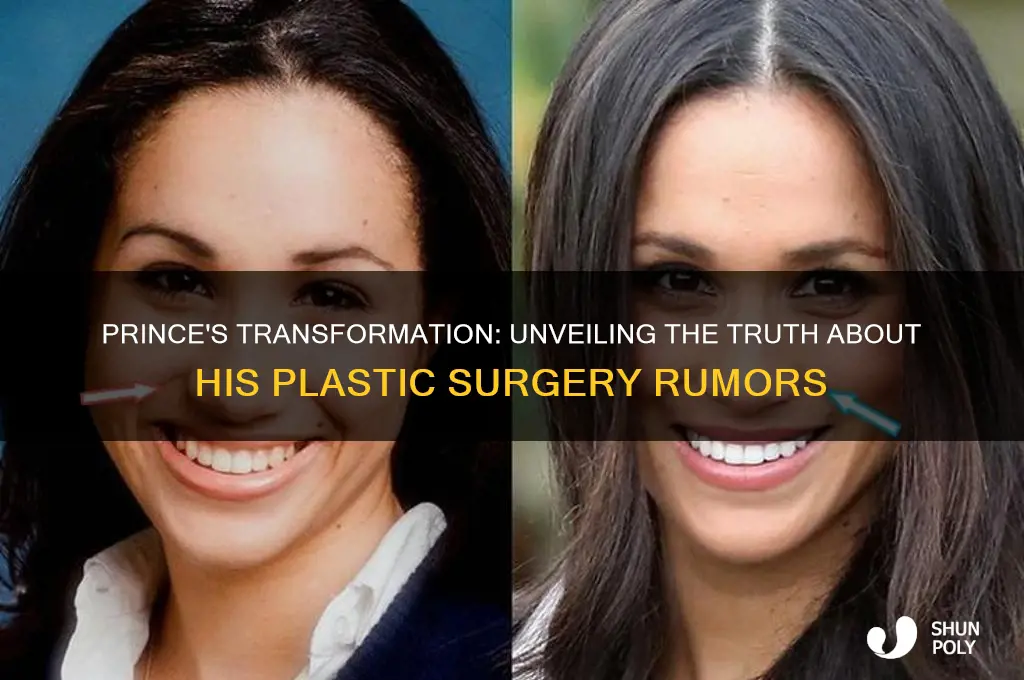 did prince get plastic surgery