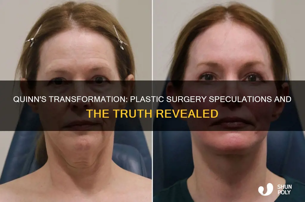 did quinnhave plastic surgery