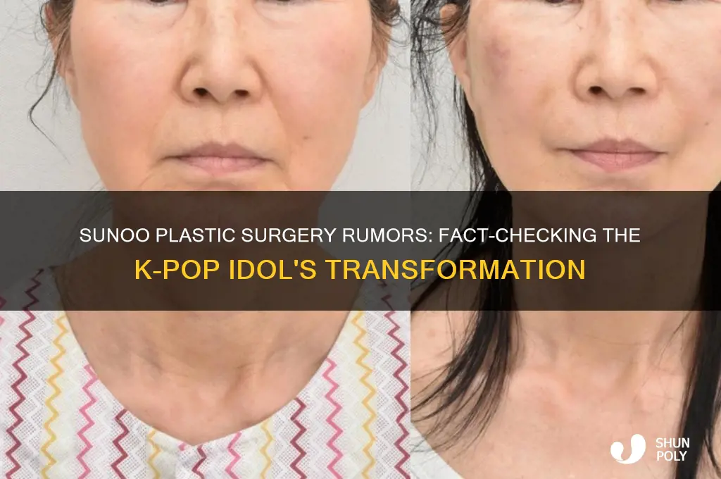 did sunoo get plastic surgery